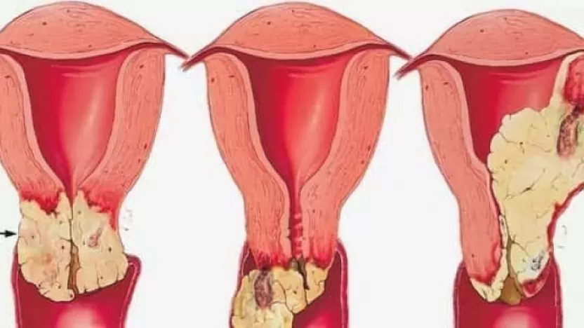 أبرز أعراض سرطان عنق الرحم المبكرة, وطرق الوقاية منه.