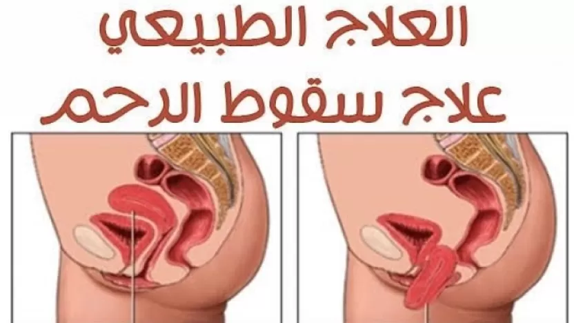 كيفية علاج هبوط الرحم؟