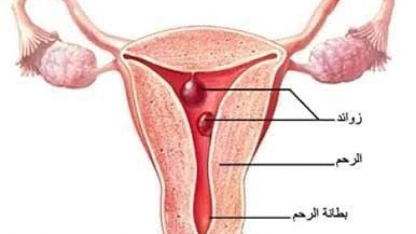 ما هي أعراض لحمية الرحم