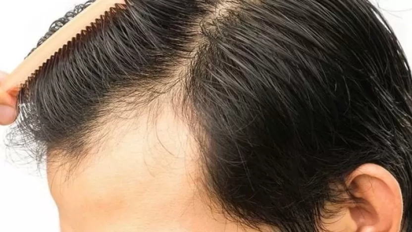 التقنية الجديدة لزراعة الشعر