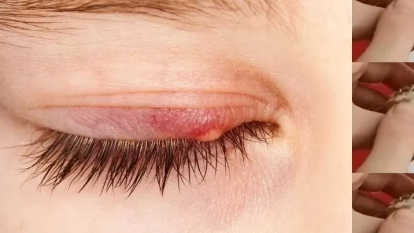أبرز طرق علاج دمل العين بالأعشاب