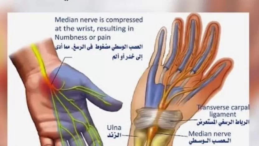 أسباب متلازمة النفق الرسغي وكيفية علاجها