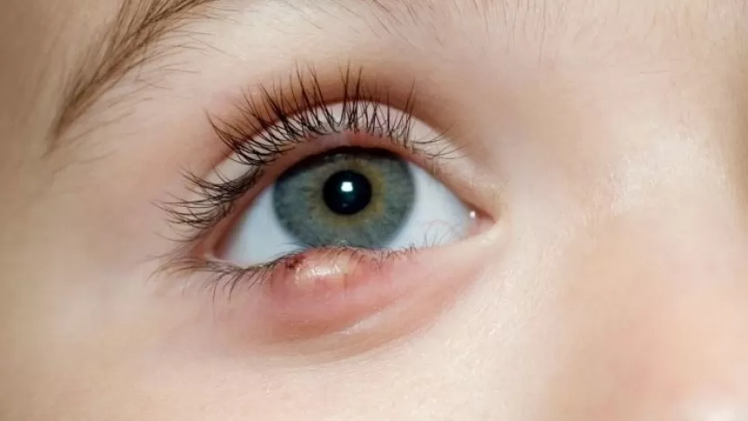 دمل العين: الأسباب والأعراض والعلاج