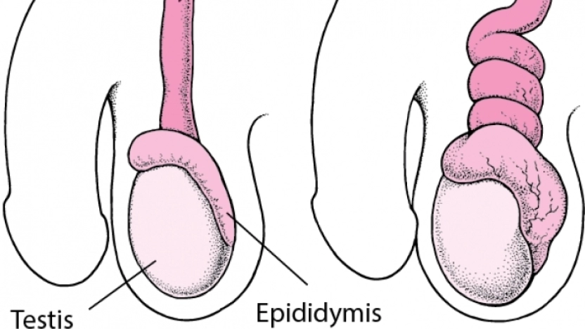 الم الخصية: الأسباب والأعراض والعلاج