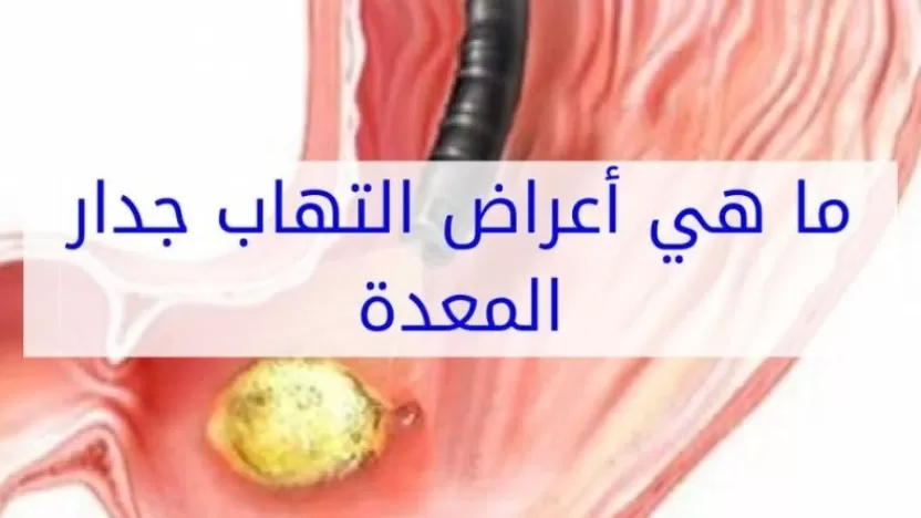 التهاب جدار المعدة اسبابه وعلاجه وطرق الوقاية منه