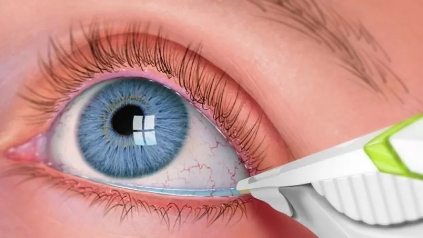 متلازمة العين الجافة.. الأسباب الأعراض وطرق العلاج