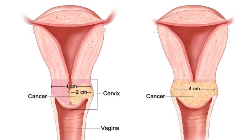 أسباب سرطان عنق الرحم وطرق علاجه