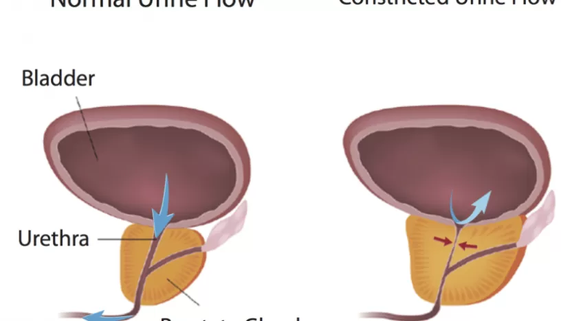 ما هي أسباب احتقان البروستاتا وطرق علاجها