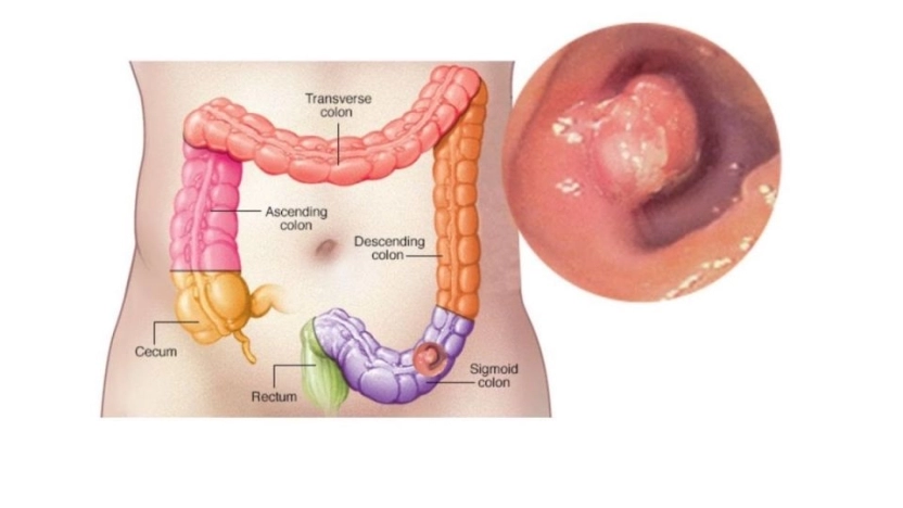 أعراض سرطان القولون وتعريفه وطريقة علاجه