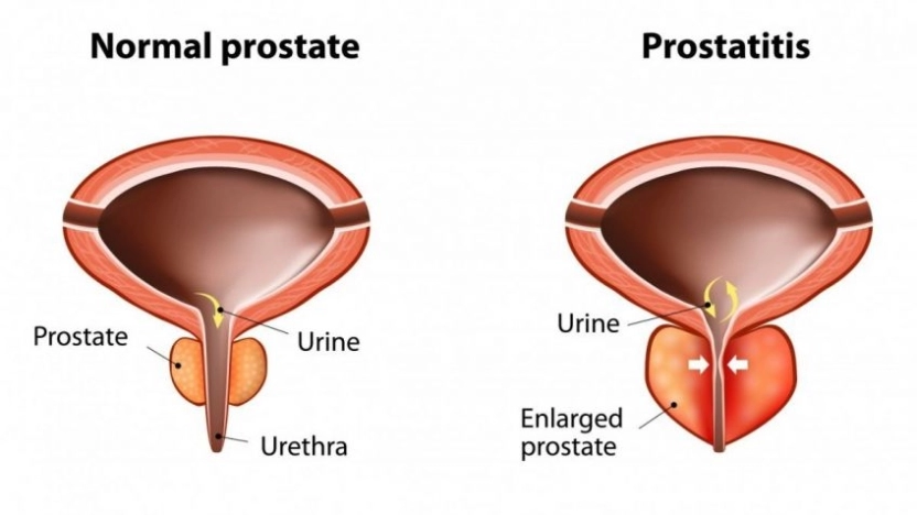 التهاب البروستات: أعراضه وأسبابه وطرق علاجه