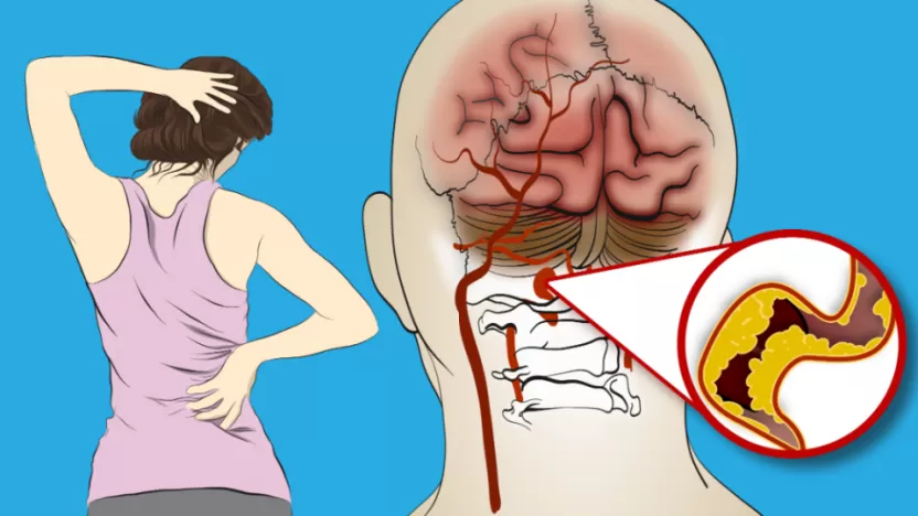 ما أعراض جلطة الدماغ؟ وما أسبابها ومضاعفاتها؟