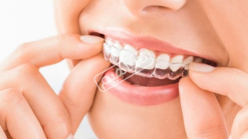 ما هي قوالب تبييض الاسنان؟ وما هي عيوبها وبدائلها؟
