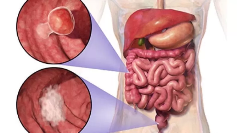 أسباب وأعراض أورام المستقيم وتشخيصه وطرق الوقاية منه
