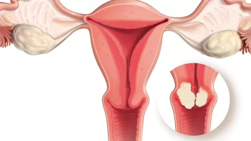 أعراض سرطان عنق الرحم المبكرة وتشخيصه وطرق علاجه