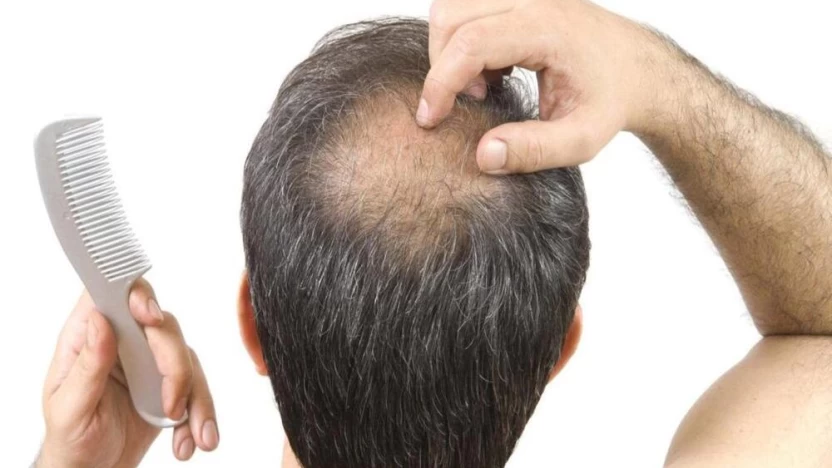 نصائح بعد  تجربتي مع زراعة الشعر في السعودية