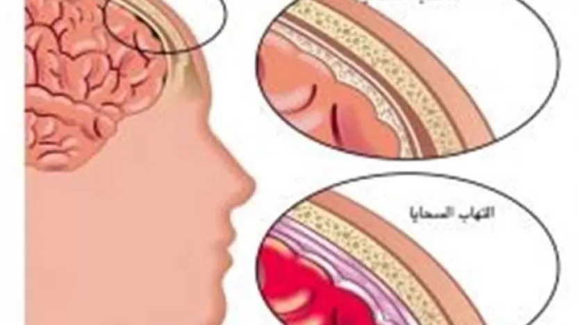 مرض التهاب السحايا الفيروسي