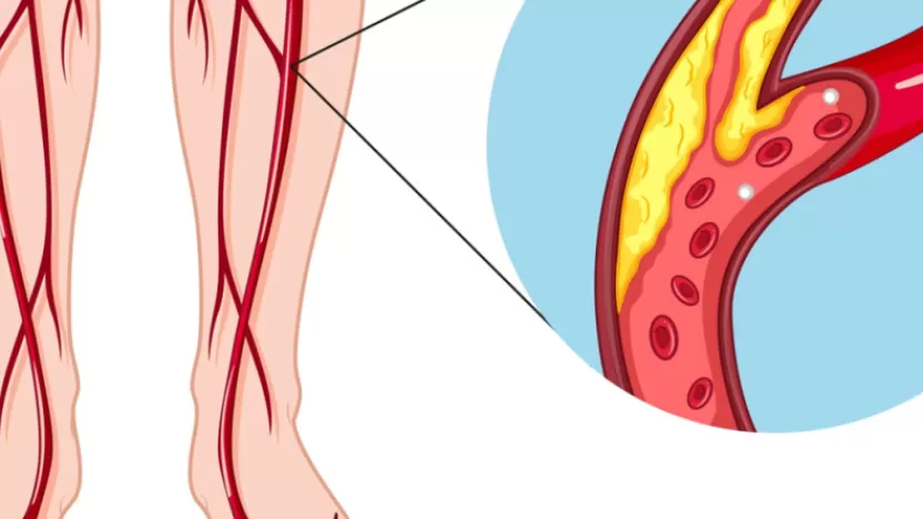 أسباب أمراض الأوعية الدموية وأعراضها وطرق معالجتها