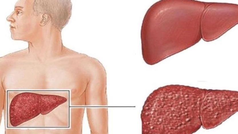 التهاب الكبد الوبائي أ أسبابه وعوامل الخطر وطرق الوقاية والعلاج