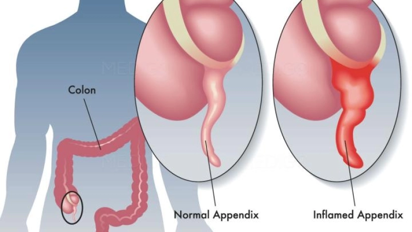 معلومات هامة لا تعرفها عن التهاب الزائدة الدودية
