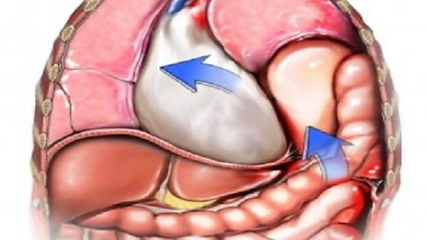 أبرز 4 علامات وأعراض لحدوث فتق الحجاب الحاجز