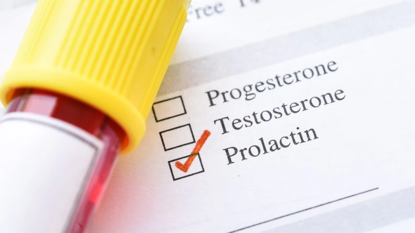 نتائج تحليل البرولاكتين Prolactin Test ومخاطره