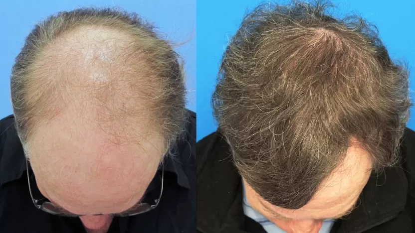 تجربتي مع زراعة الشعر وعلاج الصلع