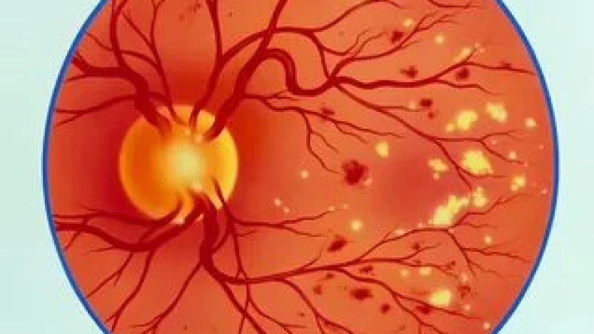 أنواع مرض اعتلال شبكية العين (Retinopathy)