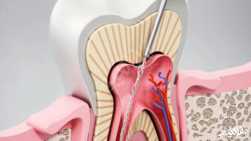 أهم أسباب التهاب عصب الأسنان وطرق العلاج الفعالة