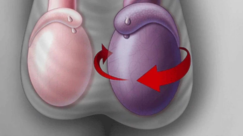 أسباب التواء الخصية، وهل سيؤثر على الخصوبة؟