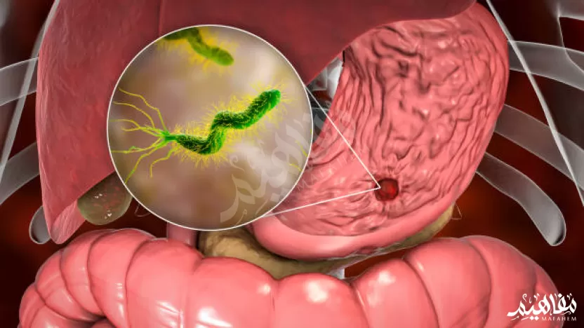 أعراض جرثومة المعدة وسبب الٱصابة وطرق العلاج