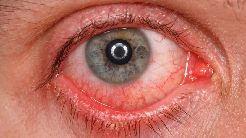 أهم أسباب احمرار بياض العين وطرق العلاج