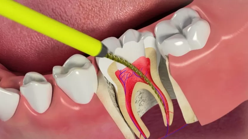 سحب عصب الأسنان الأسباب والأعراض وطرق الوقاية