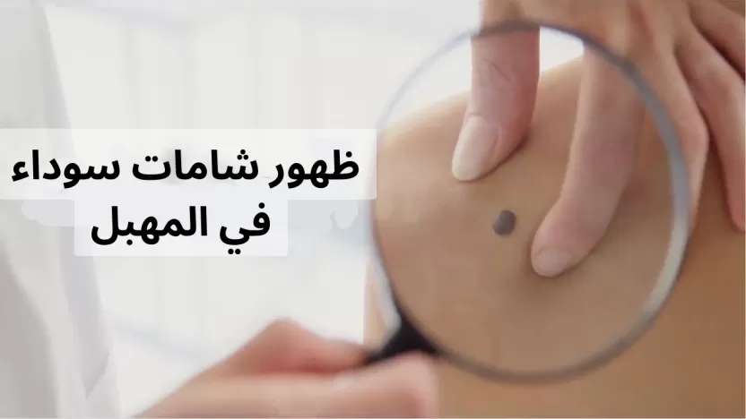 أسباب ظهور شامات سوداء في المهبل وطرق التخلص منها