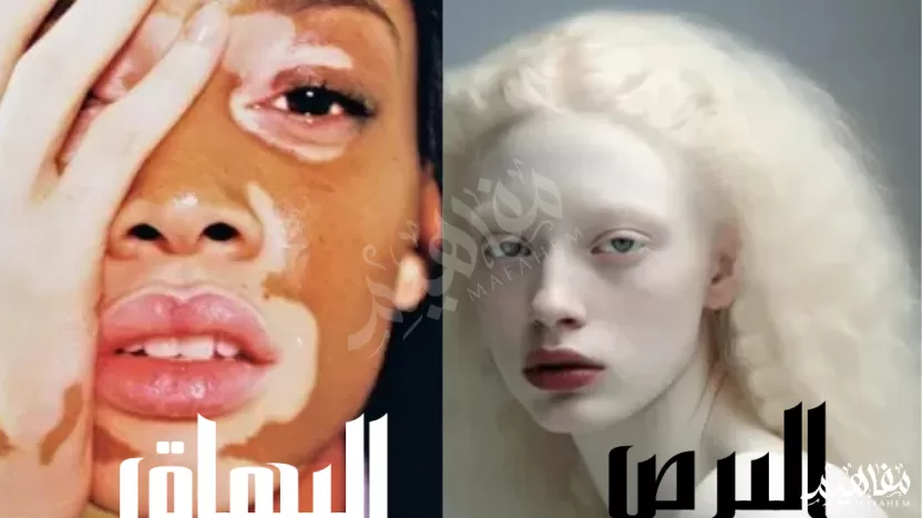 الفرق بين البرص والبهاق الفرق بين البرص والبهاق