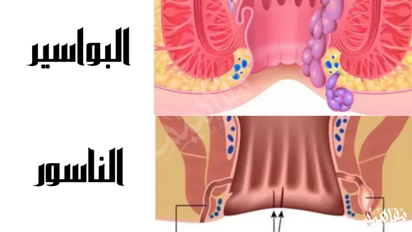 الفرق بين الناسور والبواسير