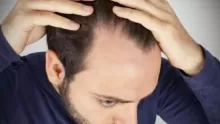 بعض أسباب حدوث الصلع