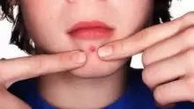 طرق علاج الدمامل بالطب البديل بوصفات بسيطة