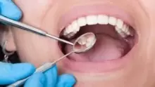 أبرز أدوية علاج بعد خلع الضرس, وأسباب خلع الضرس