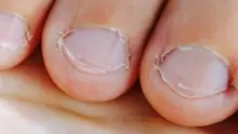 كيف أتخلص من عادة قضم الأظافر؟