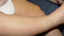 مرض السماك أعراضه وكيفية علاجه