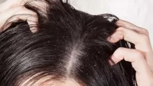 أشهر طرق التخلص من القمل