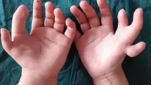 أشهر أنواع متلازمة كثرة الأصابع