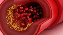 هل الكولسترول مرض مزمن؟ وما مخاطر ارتفاعه في الجسم؟