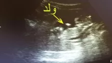ما طرق تحديد نوع الجنين في فترة الحمل