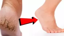طريقة إزالة تشققات القدمين في المنزل