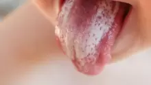 ما علاج فطريات اللسان وكيفية الوقاية منه؟