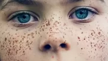 ما هو الكلف وما هي أسبابه وكيفية علاجه؟