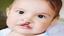 ما هي الشفة الأرنبية عند الأطفال؟ وما علاجها؟
