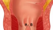أعراض الشرخ الشرجي وطرق علاجه