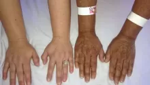 أعراض مرض اديسون بالصور